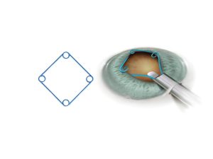 Malyugin 2.0 Ring 7.00mm Diameter